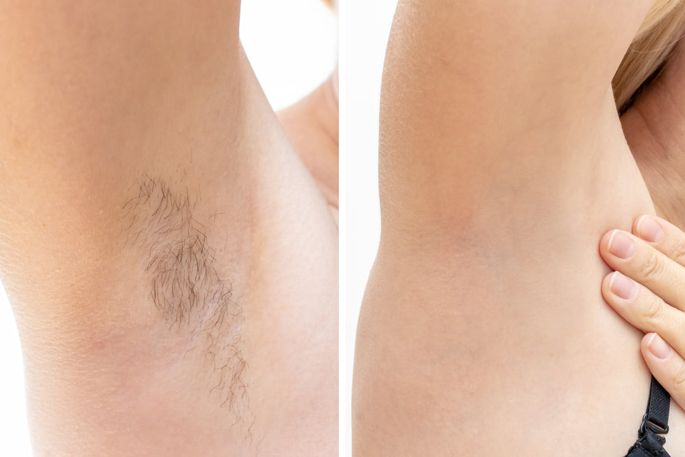 Laser Treatments for your Arms